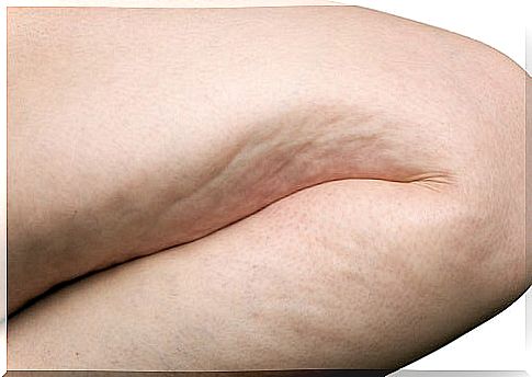 Fighting cellulite in a natural way: how?