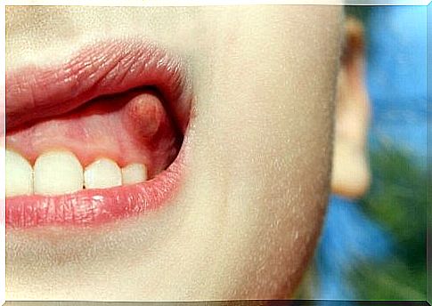 Gum abscess: 10 natural remedies to cure it