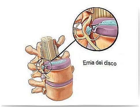 Herniated disc: causes and symptoms