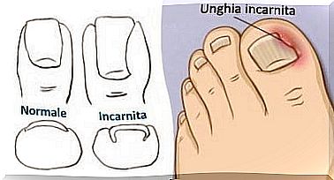 Ingrown toenail.