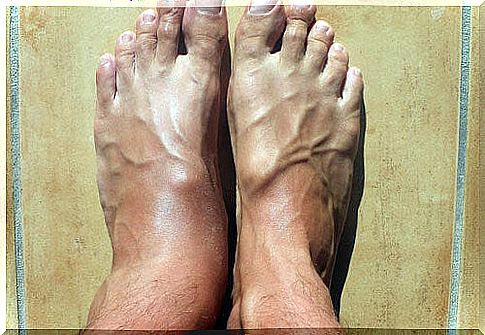 How to reduce ankle swelling?