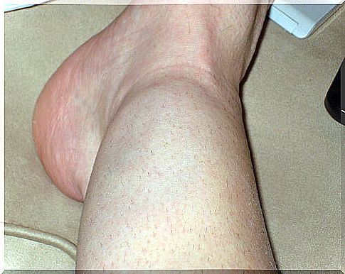 Example of swollen ankles