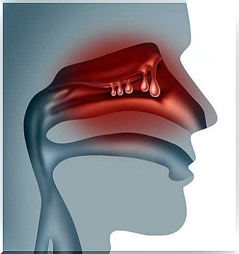 Nasal polyps: treat them with natural remedies