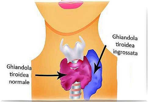 Case of hyperthyroidism