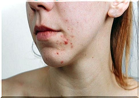 Relationship Between Diet and Acne: What Does Science Say?