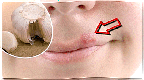 Relieve cold sores with natural remedies