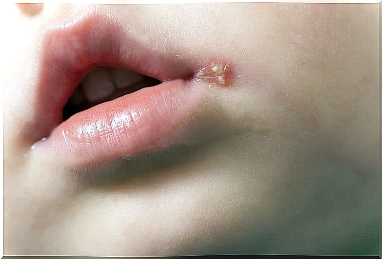 Baby mouth with herpes