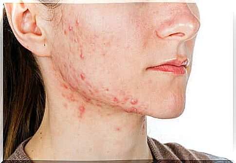 Roaccutan and severe acne