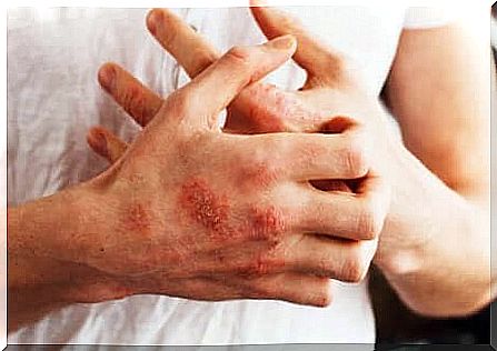 Symptoms of psoriasis.