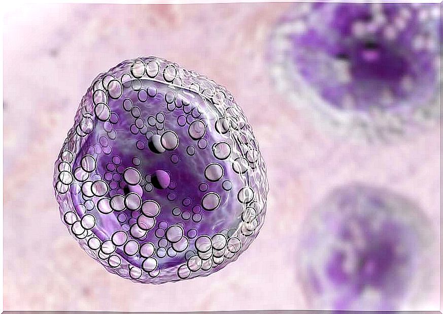 Lymphoma cells.