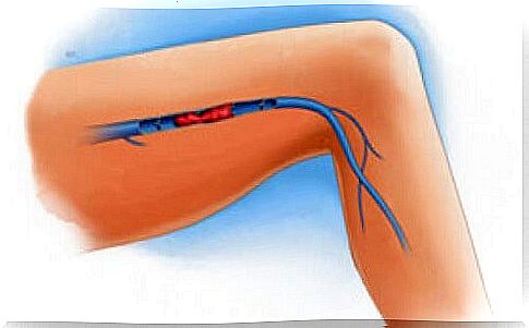 Venous thrombosis in the legs: here are the symptoms