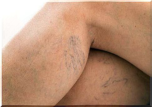 Varicose veins and venous thrombosis