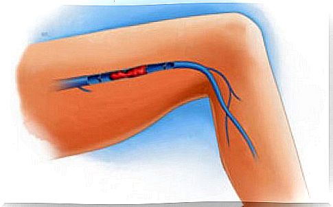 Venous thrombosis in the leg