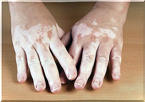 big-hands-with-vitiligo