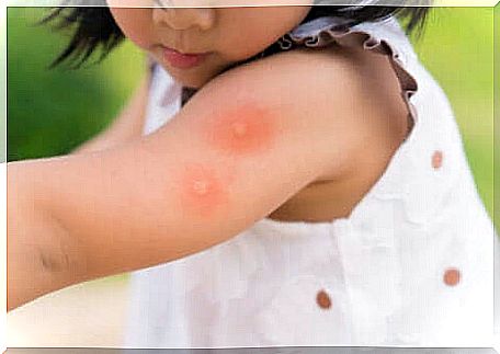 Why do mosquitoes bite, little girl with bites on her arm