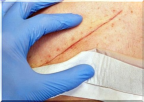 Wound closure: basic techniques